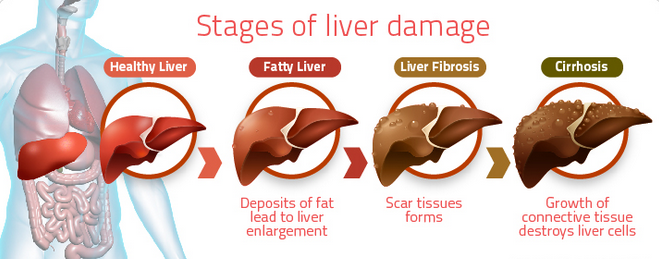 Non Alcoholic Fatty Liver Disease All Medica Global Non alcoholic fatty liver disease all medica global